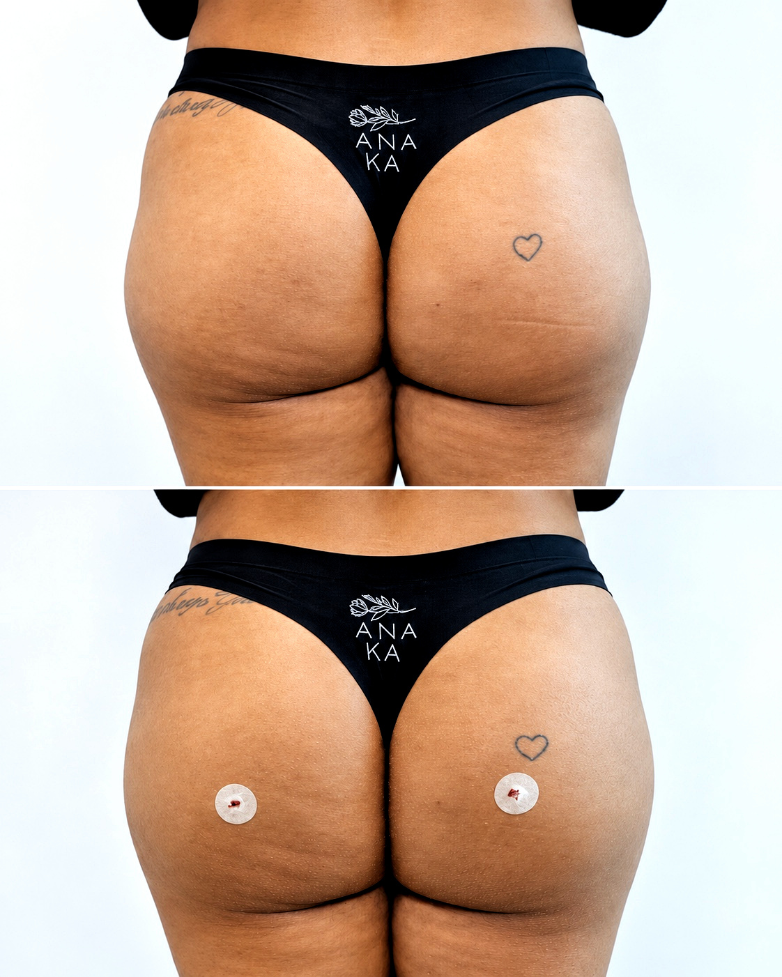 Antes e depois real de glúteos em vista posterior