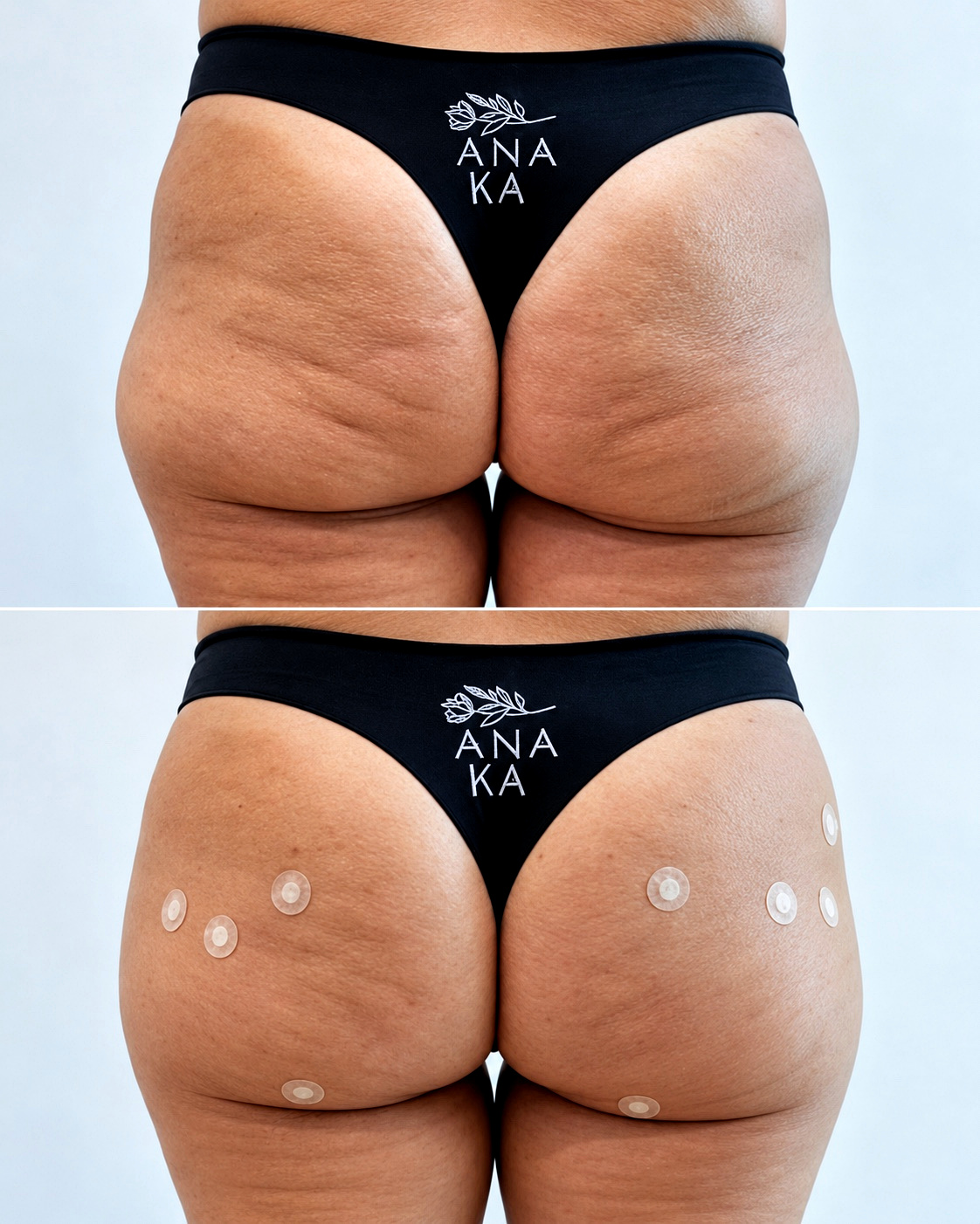 Antes e depois real de contorno glúteo com marcação em vista lateral