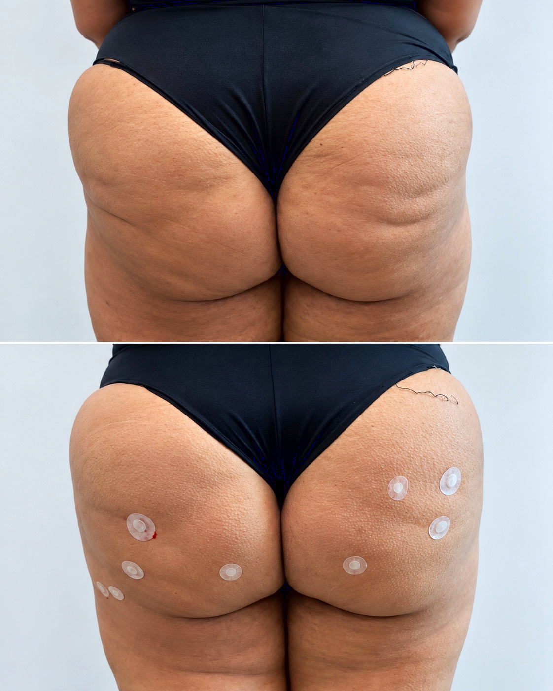 Antes e depois real de glúteos com biquíni Ana Ka