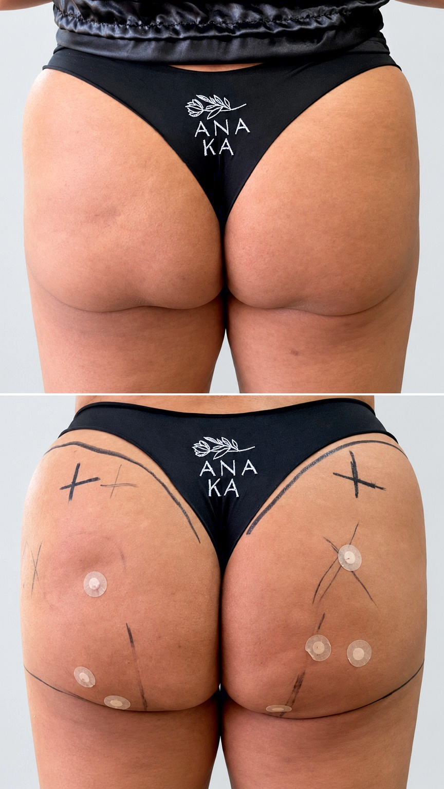 Antes e depois real de glúteos em registro clínico posterior