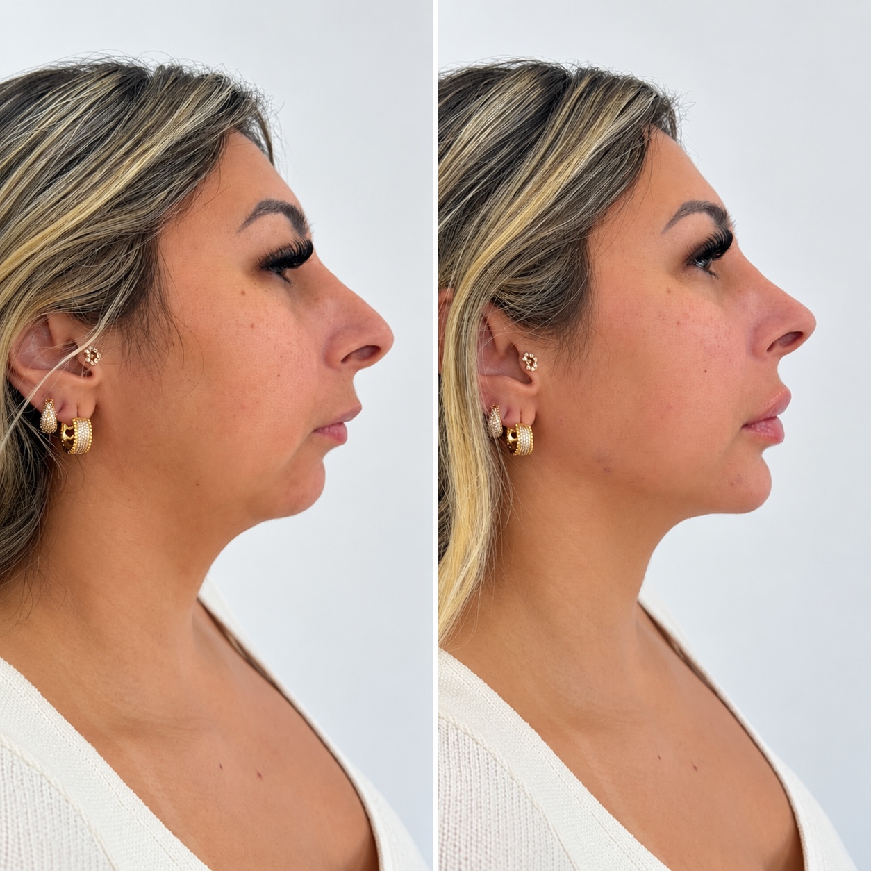 Imagem de referência para Perfiloplastia