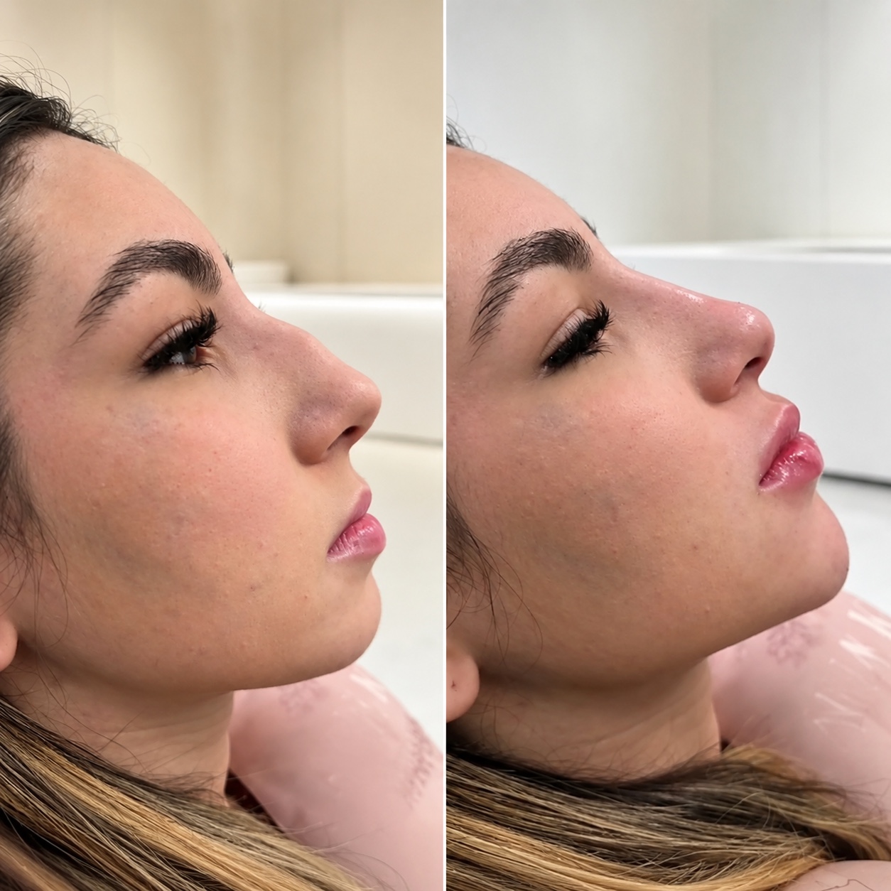 Antes e depois de perfiloplastia