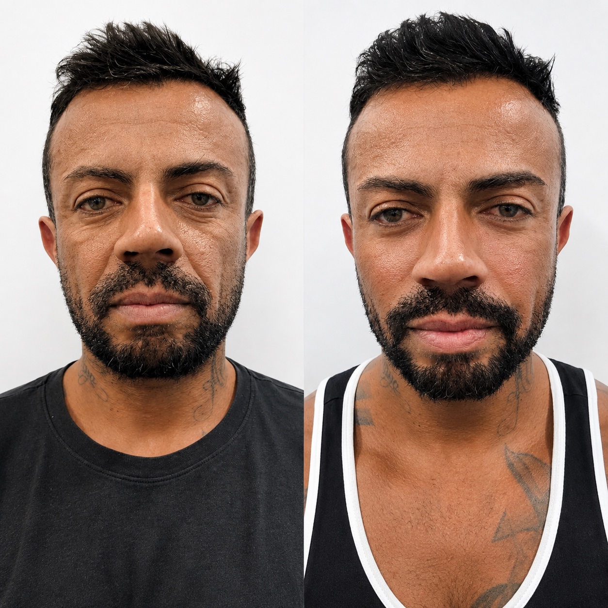 Antes e depois de bioestimulador de colágeno