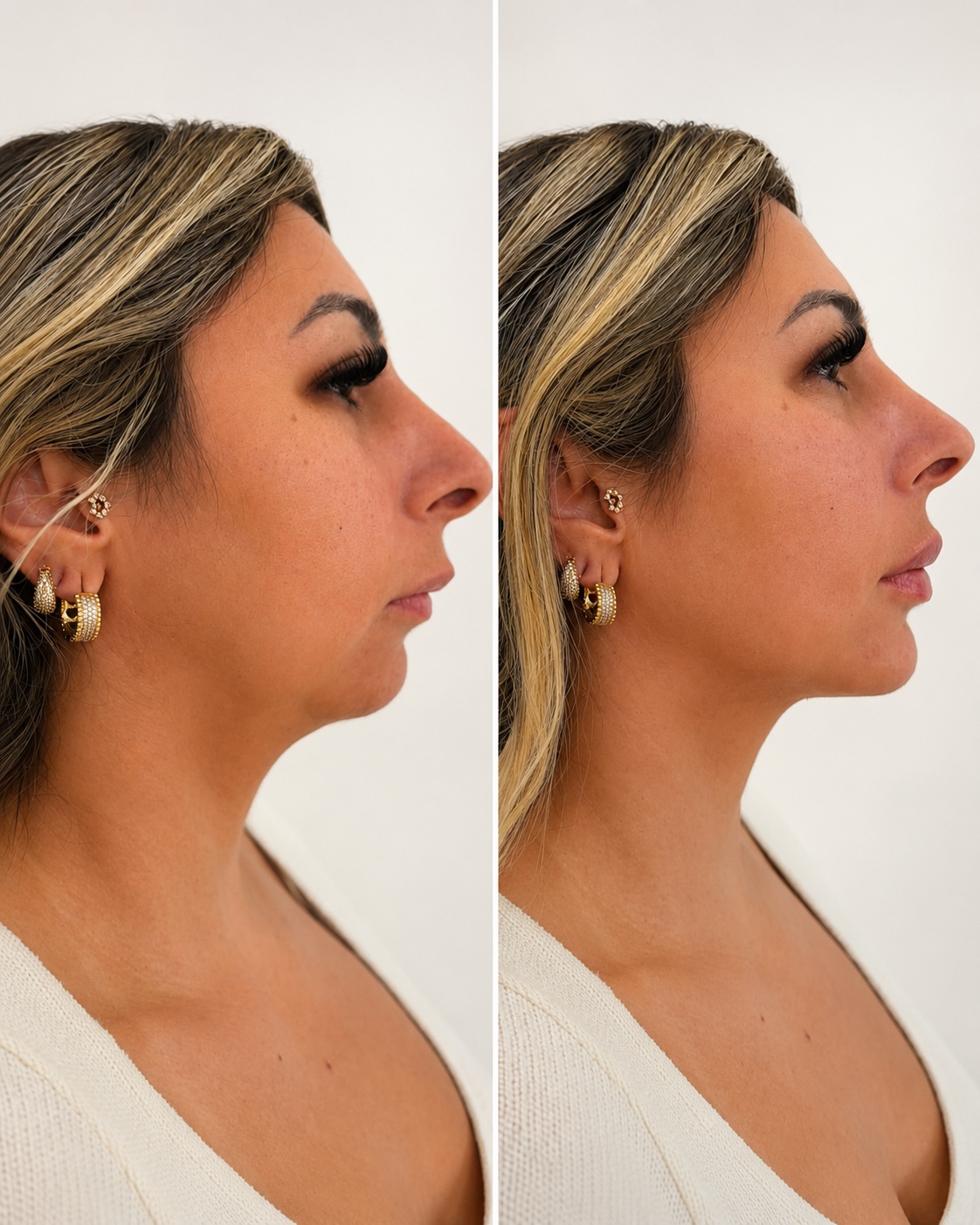 Imagem de referência para Perfiloplastia
